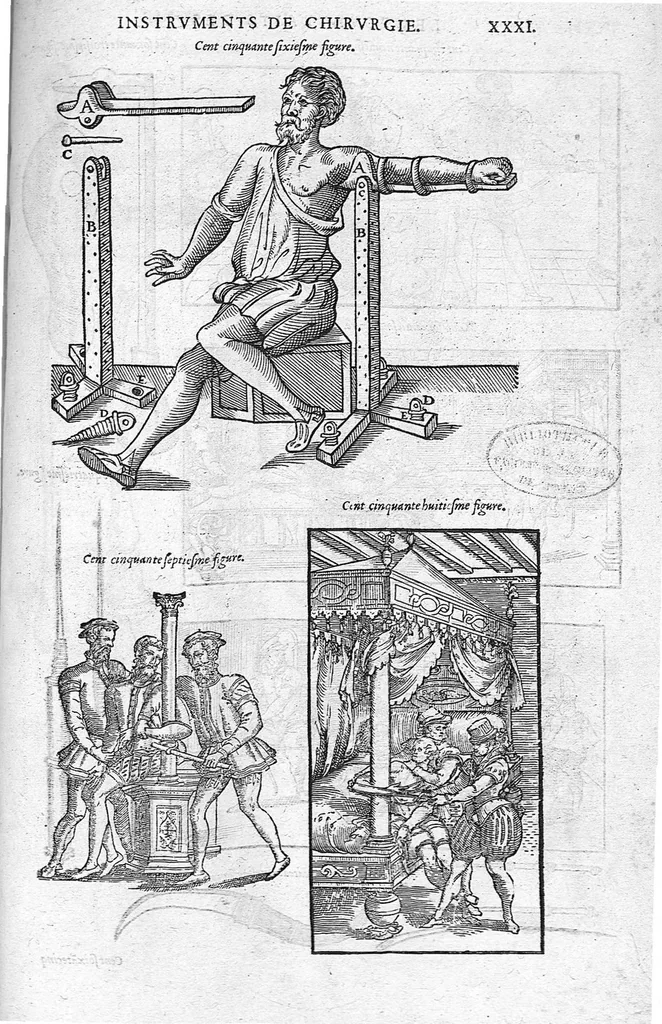 An illustration from Les Oeuvres d’Ambroise Paré, conseiller et premier chirurgien du roy, divisées en vingt-sept livres : avec les figures et portraicts tant de l’Anatomie que des instruments de chirurgie et de plusieurs monstres : reveuz et augmentez par l’autheur pour la seconde Edition, Paris,, 1579, leaf 1267