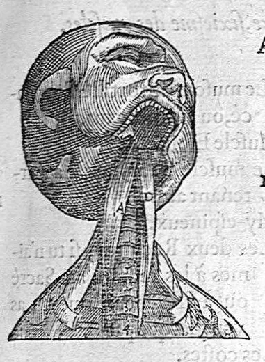 An illustration from Les Oeuvres d’Ambroise Paré, conseiller et premier chirurgien du roy, divisées en vingt-sept livres : avec les figures et portraicts tant de l’Anatomie que des instruments de chirurgie et de plusieurs monstres : reveuz et augmentez par l’autheur pour la seconde Edition, Paris,, 1579, leaf 223