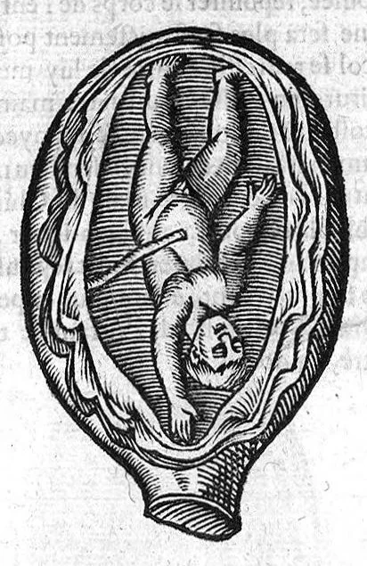 An illustration from Oeuvres de chirurgie, 1649, leaf 409