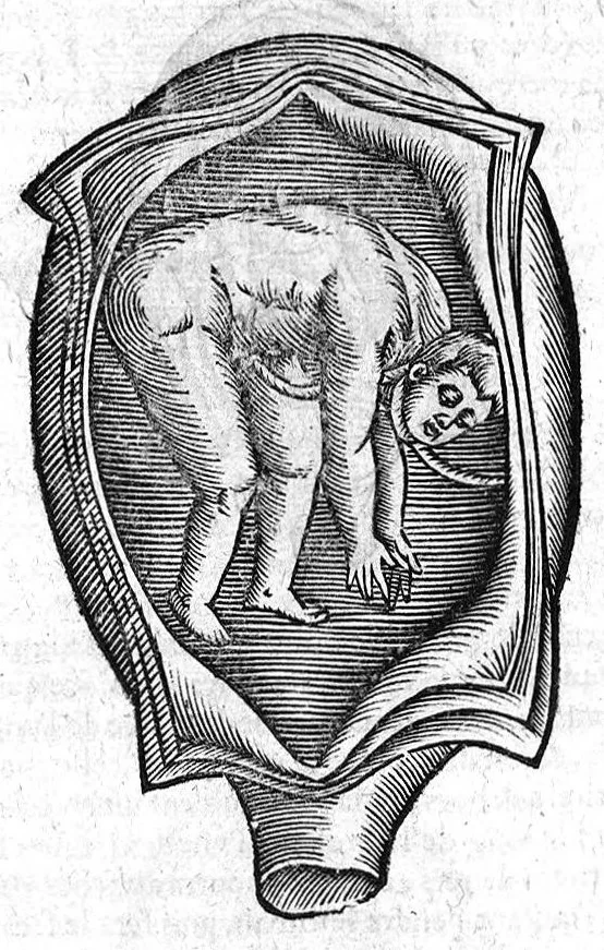 An illustration from Oeuvres de chirurgie, 1649, leaf 415