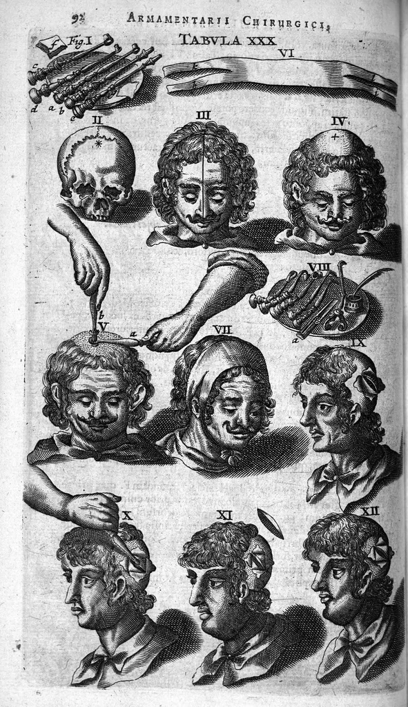 An illustration from Cheiroplotheke, seu... Armamentarium chirurgicum XLIII tabulis... exornatum. Opus posthumum..., 1656, leaf 107