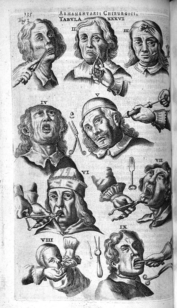 An illustration from Cheiroplotheke, seu... Armamentarium chirurgicum XLIII tabulis... exornatum. Opus posthumum..., 1656, leaf 149