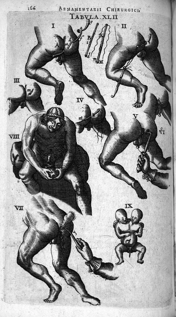 An illustration from Cheiroplotheke, seu... Armamentarium chirurgicum XLIII tabulis... exornatum. Opus posthumum..., 1656, leaf 183