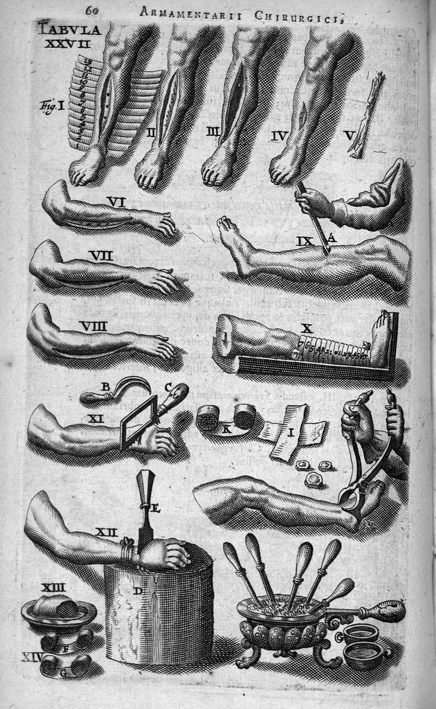 An illustration from Cheiroplotheke, seu... Armamentarium chirurgicum XLIII tabulis... exornatum. Opus posthumum..., 1656, leaf 75