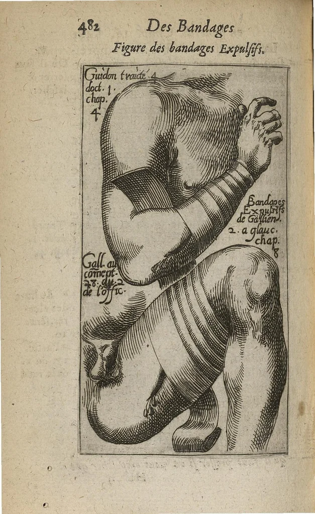 An illustration from Oeuvres du sieur Jacq. De Marque...contenant sa Methodique Introduction à la Chirurgie, divisée en deux parties...Ensemble son Traité des Bandages...me tout représenté par figures gravées en cuivre, 1662, leaf 507