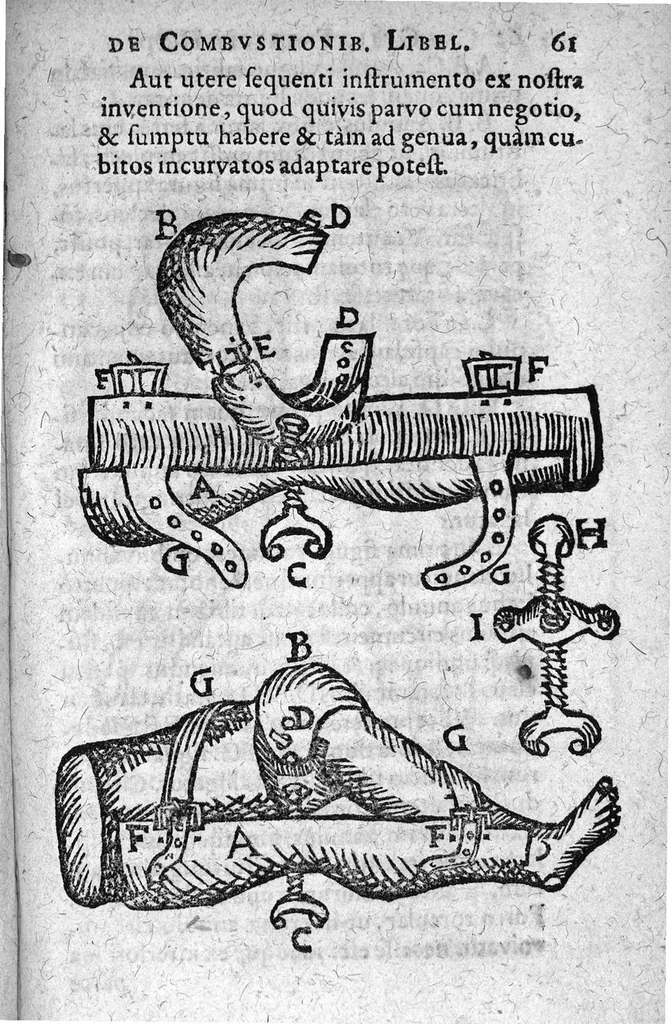 An illustration from De Combustionibus quae oleo et aqua fervida, ferro candente, pulvere tormentario, fulmine ..., 1607, leaf 76