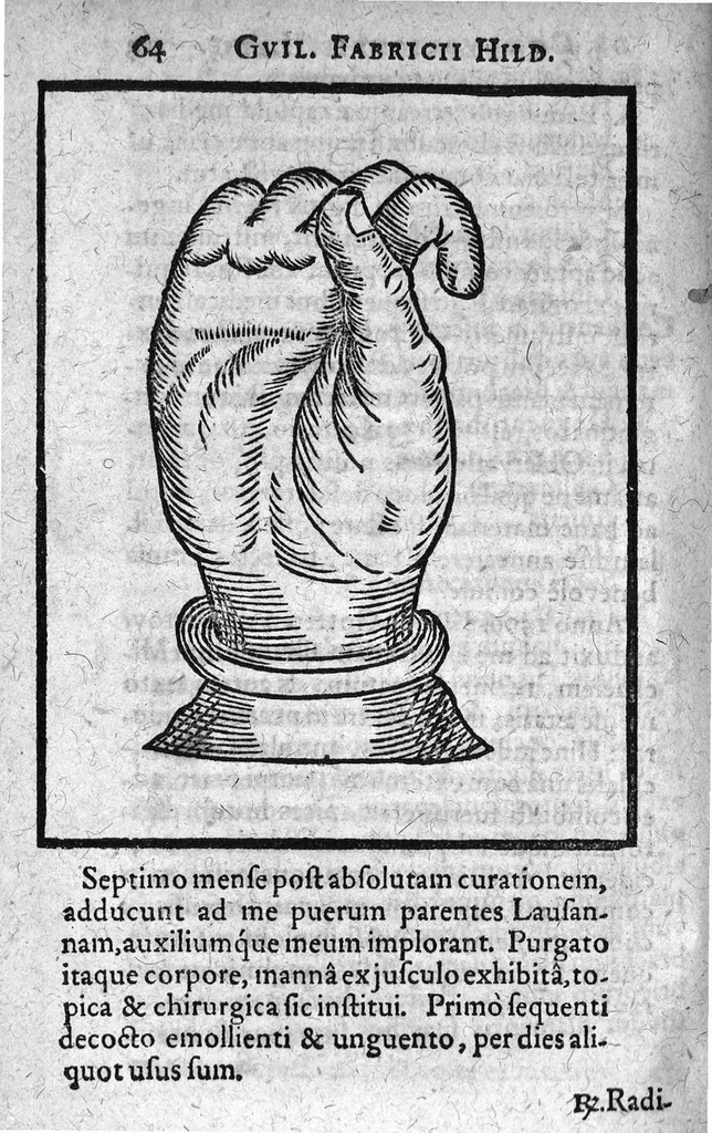 An illustration from De Combustionibus quae oleo et aqua fervida, ferro candente, pulvere tormentario, fulmine ..., 1607, leaf 79
