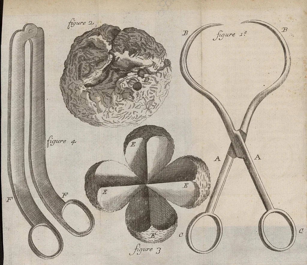 An illustration from Traité des pertes de sang, de quelque espèce qu'ellles soient avec leur remede specifique, nouvellement découvert...accompagné de sa lettre sur la nature & la guerison du cancer, 1697, leaf 169