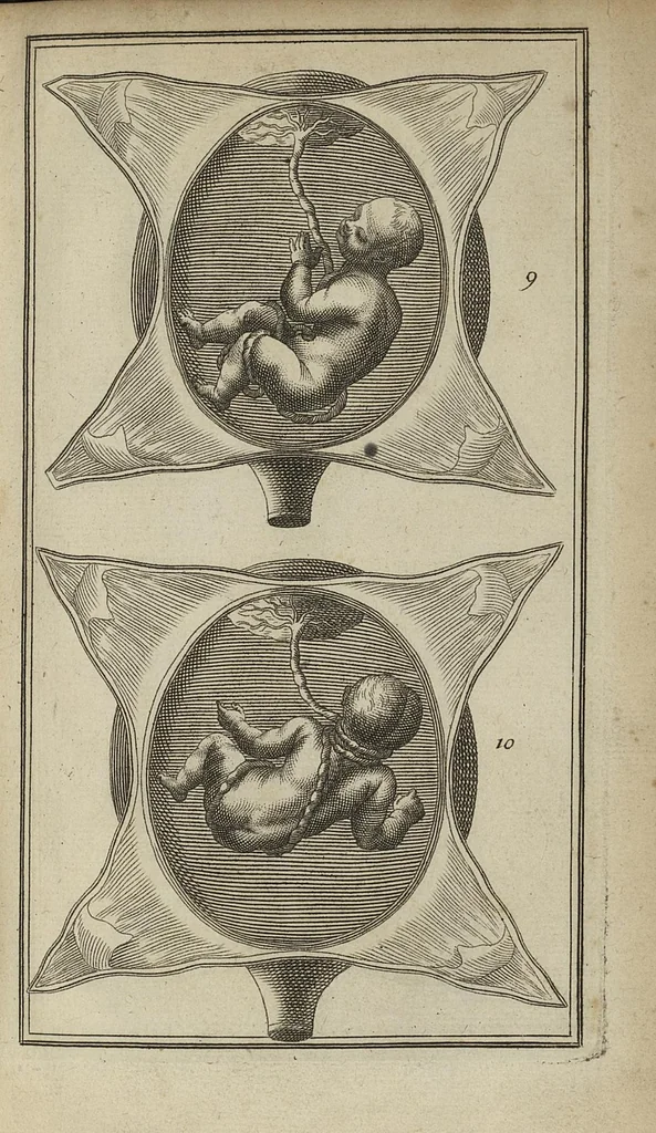 An illustration from La pratique des accouchemens, [suivi par] réponse à l'avertissement, réponse de Mr Peu aux observations particulières de Mr Mauriceau sur la grossesse et l'acouchement des femmes, 1694, leaf 486