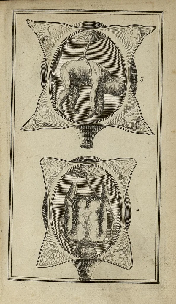 An illustration from La pratique des accouchemens, [suivi par] réponse à l'avertissement, réponse de Mr Peu aux observations particulières de Mr Mauriceau sur la grossesse et l'acouchement des femmes, 1694, leaf 488