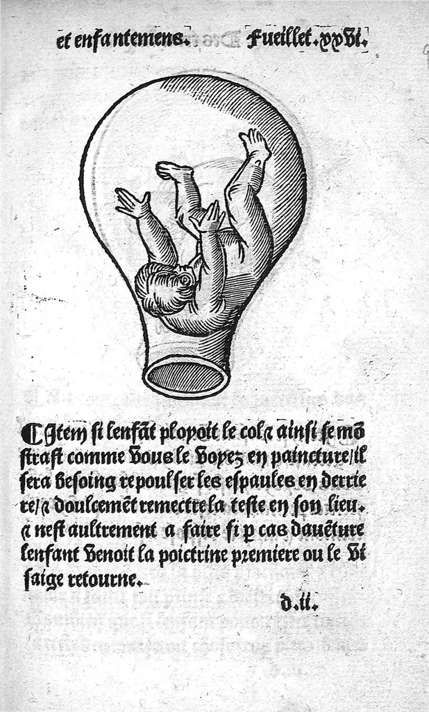 An illustration from Des divers travaulx et enfantemens des femmes, et par quel moyen lon doit survenir aux accidens qui peuvent escheoir devant et apres iceulx travaulx. Item quel lait et quelle nourrisse on doit eslire aux enfans : ensemble aucuns remedes concernens plusieurs maladies survenantes ausdits enfans nouveaux nez. Livret fort utile et duysant pour survenir a beaucoup de necessitez. Compose premierement en latin, par excellent medicin de Francfort, maistre Euchaire Rodion, et depuis tourne en langue françoyse, a lutilite de plusieurs personnes, 1536, leaf 50