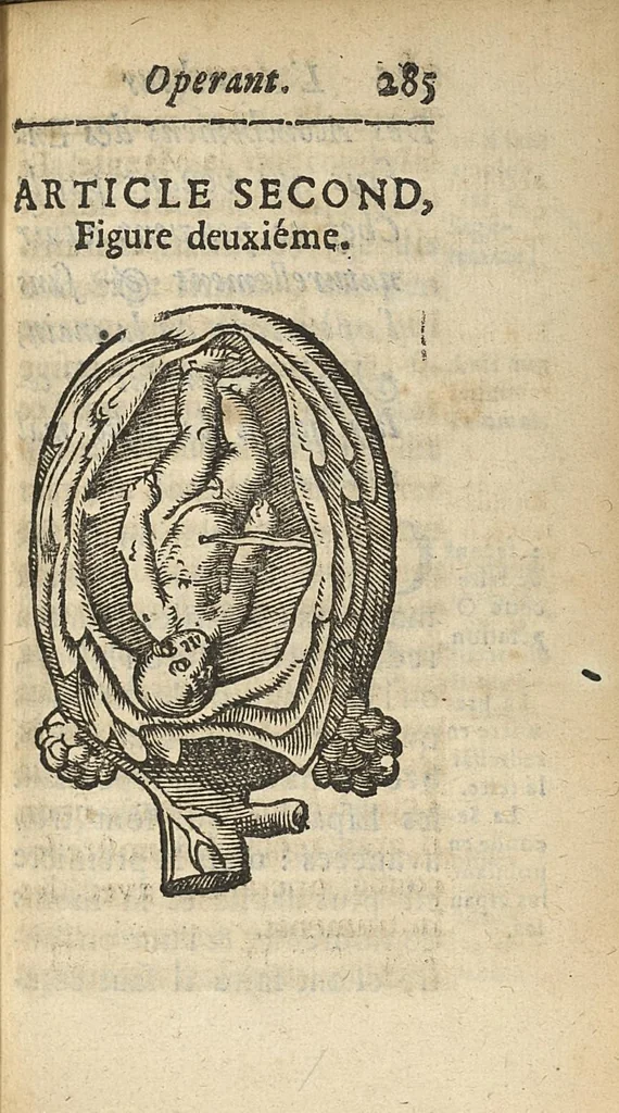 An illustration from L'accoucheur methodique, qui enseigne la maniere d'operer dans tous les accouchements naturels et artificiels..., 1676, leaf 316