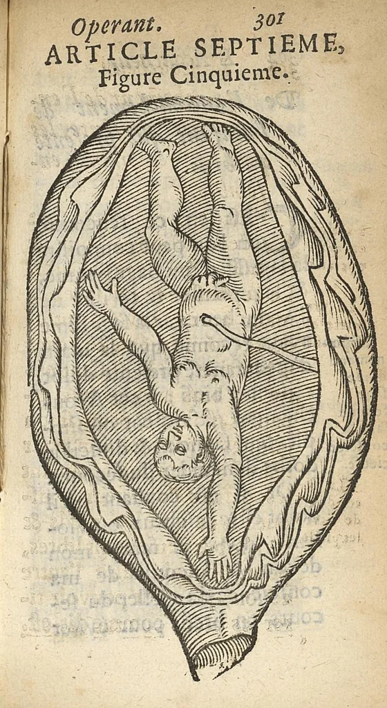 An illustration from L'accoucheur methodique, qui enseigne la maniere d'operer dans tous les accouchements naturels et artificiels..., 1676, leaf 332