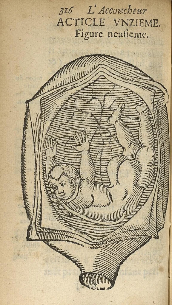 An illustration from L'accoucheur methodique, qui enseigne la maniere d'operer dans tous les accouchements naturels et artificiels..., 1676, leaf 347