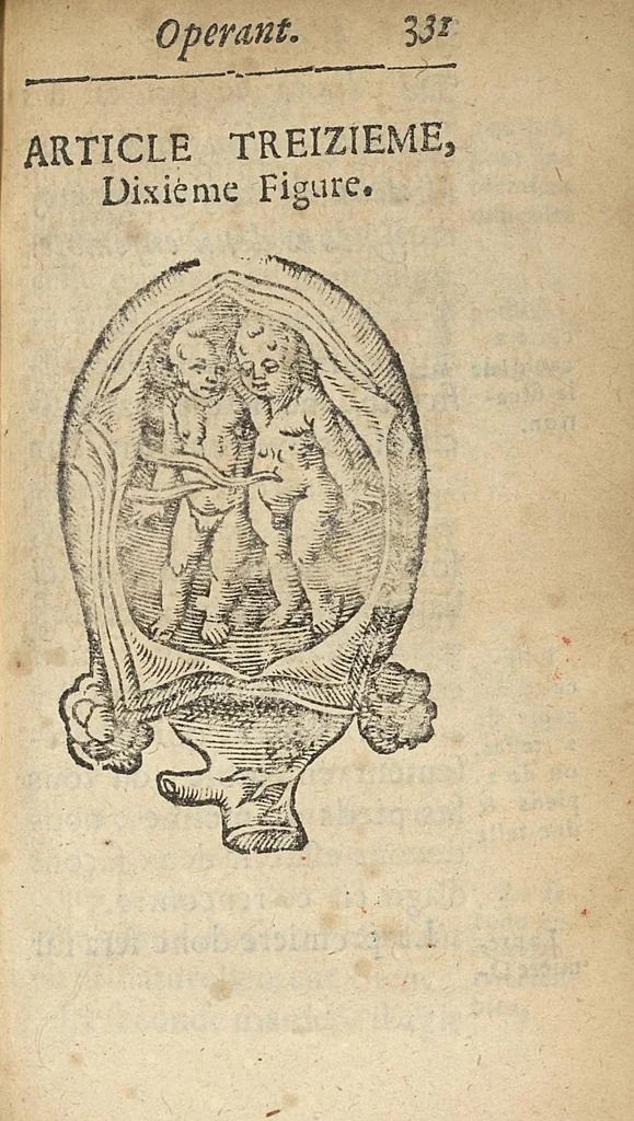 An illustration from L'accoucheur methodique, qui enseigne la maniere d'operer dans tous les accouchements naturels et artificiels..., 1676, leaf 362