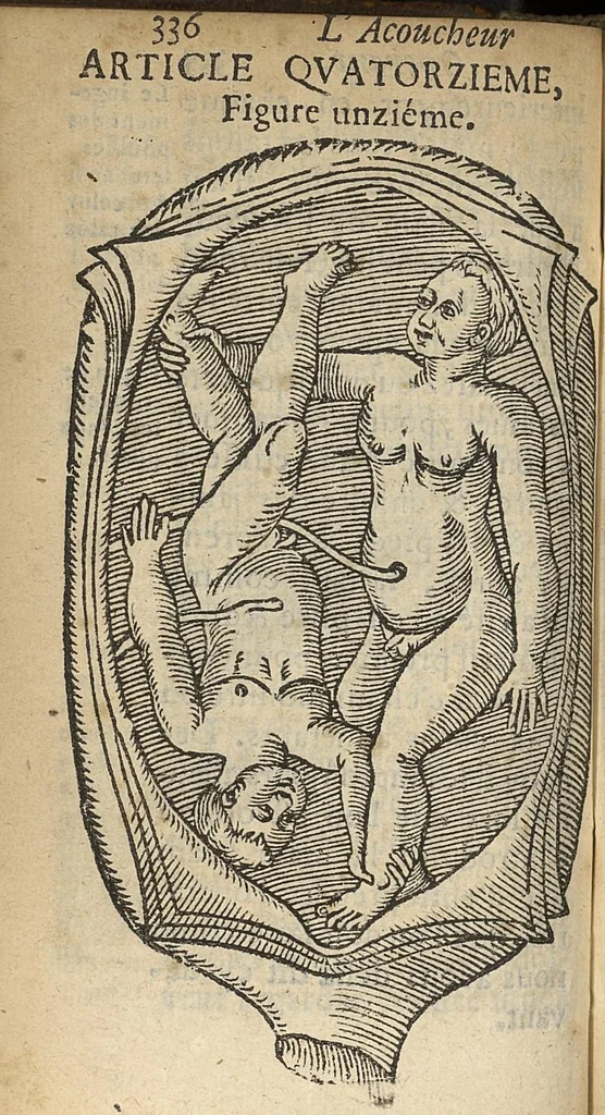 An illustration from L'accoucheur methodique, qui enseigne la maniere d'operer dans tous les accouchements naturels et artificiels..., 1676, leaf 367