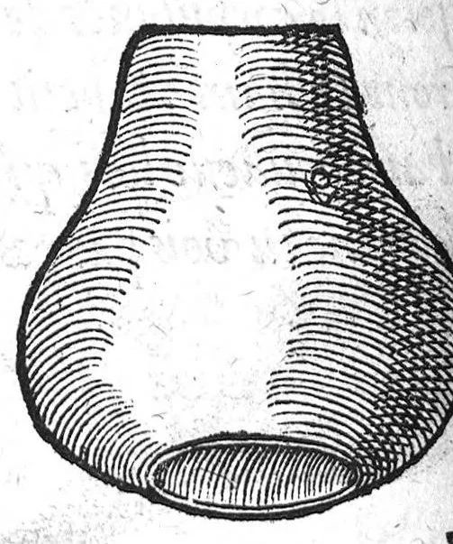 An illustration from Deux livres de chirurgie, I. De la generation de l’homme, et maniere d’extraire les enfans hors du ventre de la mere, ensemble ce qu’il faut faire pour la faire mieux, et plus tost accoucher, avec la cure de plusieurs maladies qui luy peuvent survenir. 2. Des monstres tant terrestres que marins, avec leurs portrait. Plus un petit traité des plaies faites aux parties nerveuses. Par Ambroise Paré, premier Chirurgien du Roy, et juré à Paris,, 1573, leaf 175