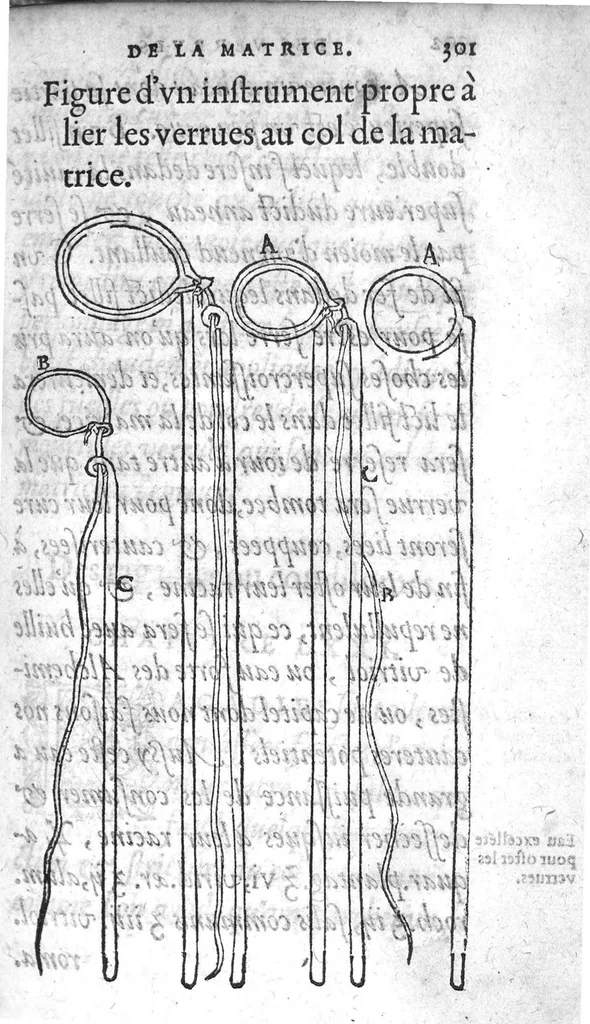 An illustration from Deux livres de chirurgie, I. De la generation de l’homme, et maniere d’extraire les enfans hors du ventre de la mere, ensemble ce qu’il faut faire pour la faire mieux, et plus tost accoucher, avec la cure de plusieurs maladies qui luy peuvent survenir. 2. Des monstres tant terrestres que marins, avec leurs portrait. Plus un petit traité des plaies faites aux parties nerveuses. Par Ambroise Paré, premier Chirurgien du Roy, et juré à Paris,, 1573, leaf 320