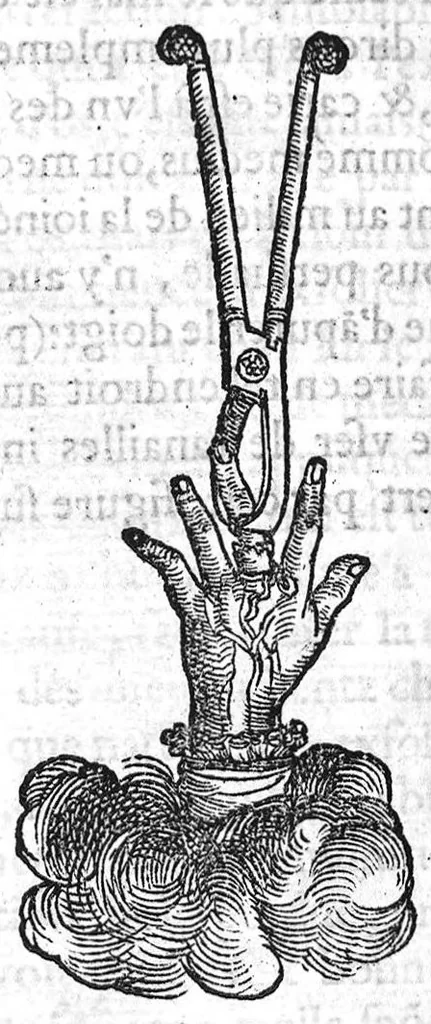 An illustration from La maniere de traicter les playes faictes tant par hacquebutes, que par fleches : et les accidentz d’icelles, comme fractures et caries des os, gangrene et mortification : avec les pourtraictz des instrumentz necessaires pour leur curation. Et la methode de curer les combustions principalement faictes par la pouldre à canon. Le tout composé par Ambroise Paré, maistre Barbier Chirurgien à Paris, 1552, leaf 101