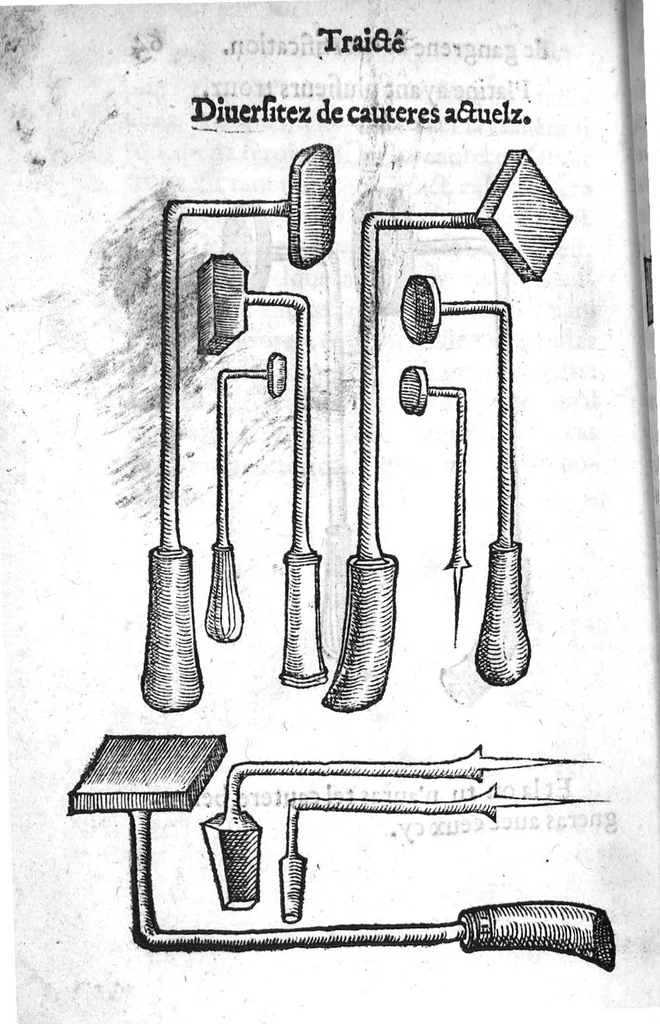 An illustration from La maniere de traicter les playes faictes tant par hacquebutes, que par fleches : et les accidentz d’icelles, comme fractures et caries des os, gangrene et mortification : avec les pourtraictz des instrumentz necessaires pour leur curation. Et la methode de curer les combustions principalement faictes par la pouldre à canon. Le tout composé par Ambroise Paré, maistre Barbier Chirurgien à Paris, 1552, leaf 143