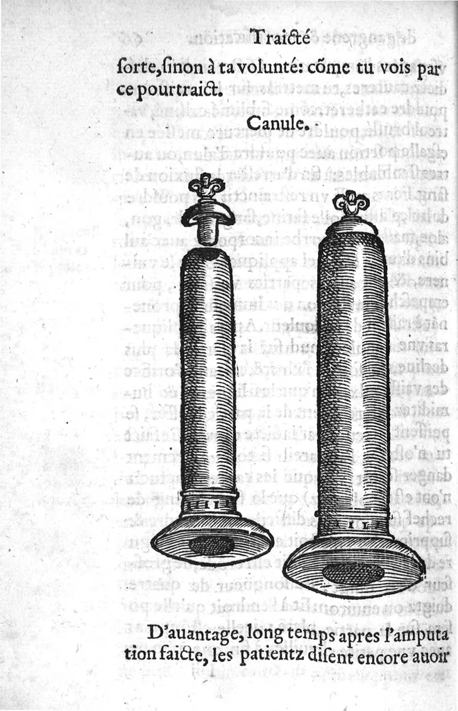 An illustration from La maniere de traicter les playes faictes tant par hacquebutes, que par fleches : et les accidentz d’icelles, comme fractures et caries des os, gangrene et mortification : avec les pourtraictz des instrumentz necessaires pour leur curation. Et la methode de curer les combustions principalement faictes par la pouldre à canon. Le tout composé par Ambroise Paré, maistre Barbier Chirurgien à Paris, 1552, leaf 147