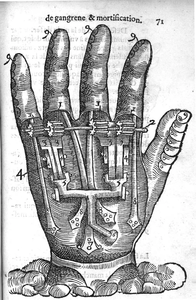 An illustration from La maniere de traicter les playes faictes tant par hacquebutes, que par fleches : et les accidentz d’icelles, comme fractures et caries des os, gangrene et mortification : avec les pourtraictz des instrumentz necessaires pour leur curation. Et la methode de curer les combustions principalement faictes par la pouldre à canon. Le tout composé par Ambroise Paré, maistre Barbier Chirurgien à Paris, 1552, leaf 156