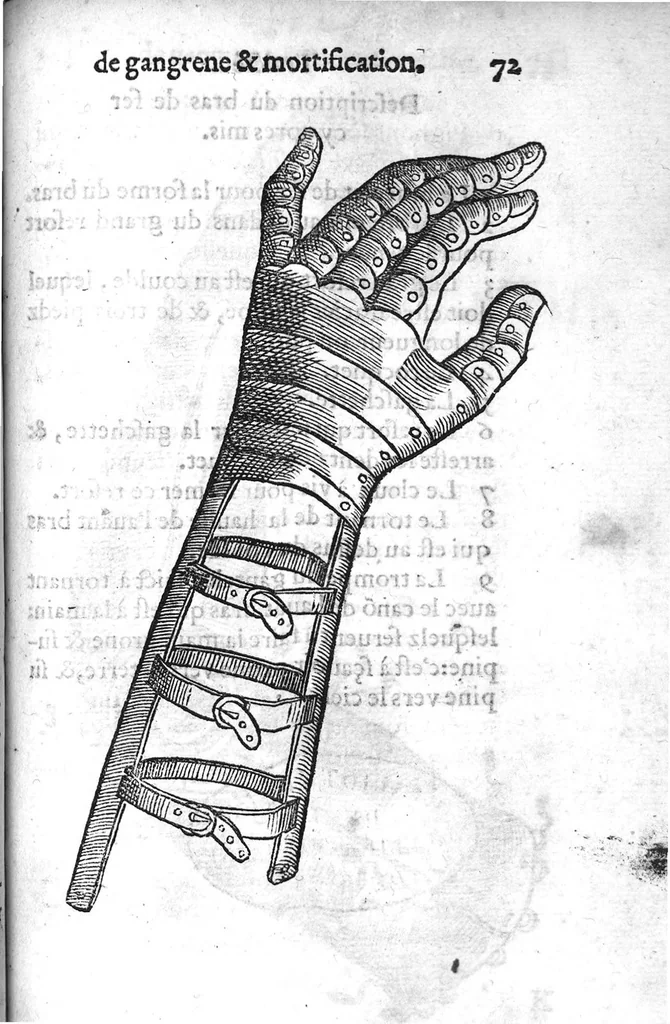 An illustration from La maniere de traicter les playes faictes tant par hacquebutes, que par fleches : et les accidentz d’icelles, comme fractures et caries des os, gangrene et mortification : avec les pourtraictz des instrumentz necessaires pour leur curation. Et la methode de curer les combustions principalement faictes par la pouldre à canon. Le tout composé par Ambroise Paré, maistre Barbier Chirurgien à Paris, 1552, leaf 158