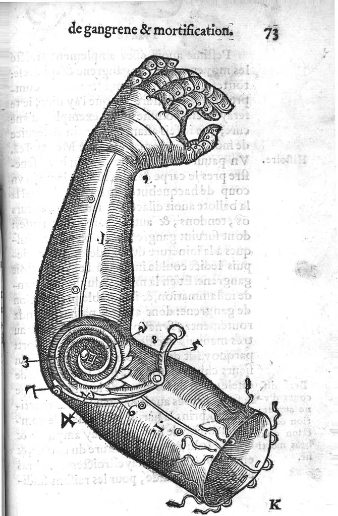 An illustration from La maniere de traicter les playes faictes tant par hacquebutes, que par fleches : et les accidentz d’icelles, comme fractures et caries des os, gangrene et mortification : avec les pourtraictz des instrumentz necessaires pour leur curation. Et la methode de curer les combustions principalement faictes par la pouldre à canon. Le tout composé par Ambroise Paré, maistre Barbier Chirurgien à Paris, 1552, leaf 160