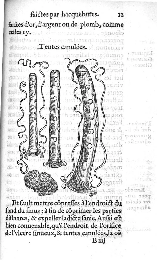 An illustration from La maniere de traicter les playes faictes tant par hacquebutes, que par fleches : et les accidentz d’icelles, comme fractures et caries des os, gangrene et mortification : avec les pourtraictz des instrumentz necessaires pour leur curation. Et la methode de curer les combustions principalement faictes par la pouldre à canon. Le tout composé par Ambroise Paré, maistre Barbier Chirurgien à Paris, 1552, leaf 38