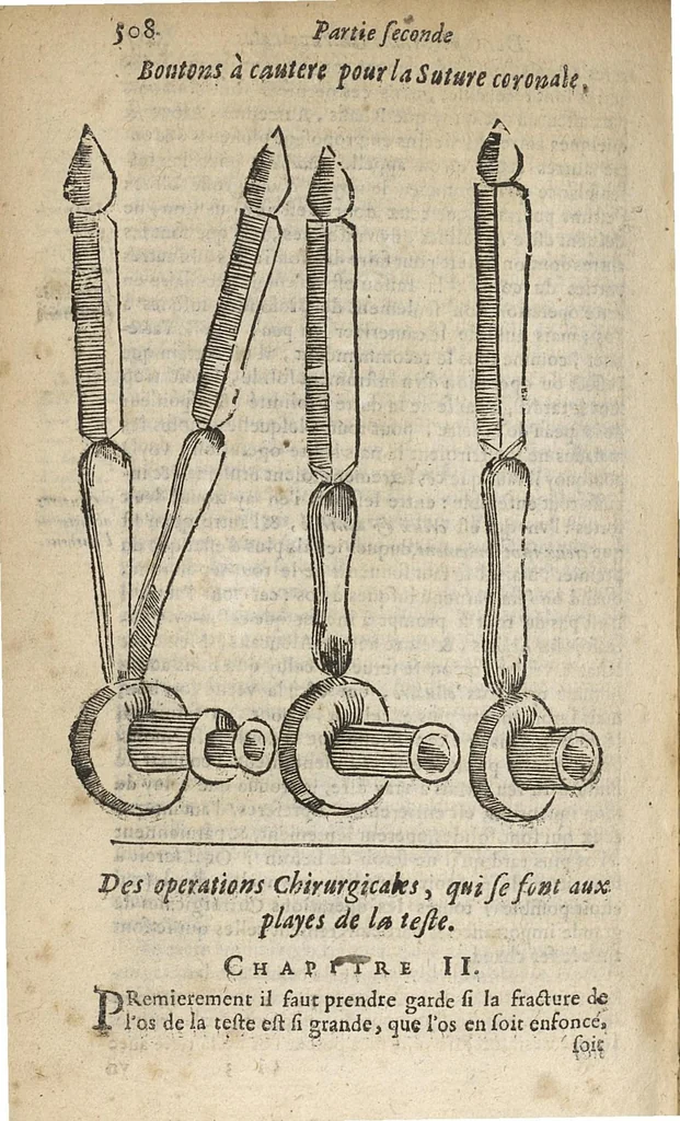 An illustration from Oeuvres chirurgicales...divisées en deux parties...derniere edition soigneusement reveue & enrichie de diverses figures inventées par l'autheur, 1658, leaf 521