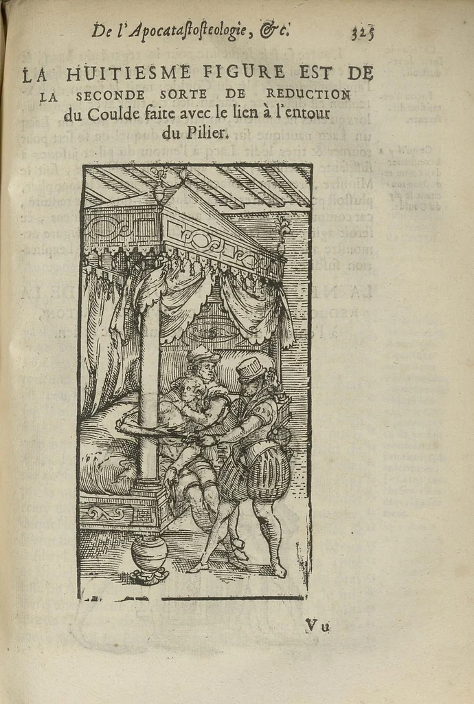 An illustration from L'Oeconomie chirurgicale, pour le restablissement des parties molles du corps humain. Contenant les principes de chirurgie, & un Traitté methodique de la garison de la peste, & de tous ses accidents, par le moyen d'un remede experimenté. Et nouvellement mis en lumiere..., 1671, leaf 692