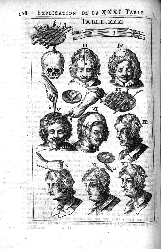 An illustration from L'arcenal de chirurgie, 1675, leaf 123