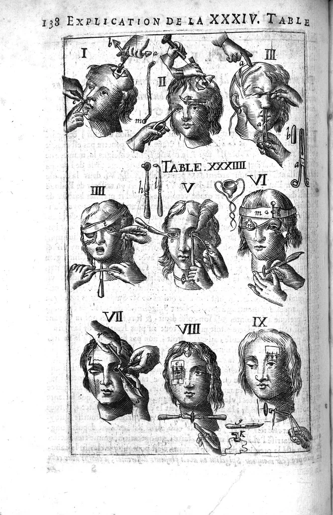 An illustration from L'arcenal de chirurgie, 1675, leaf 153
