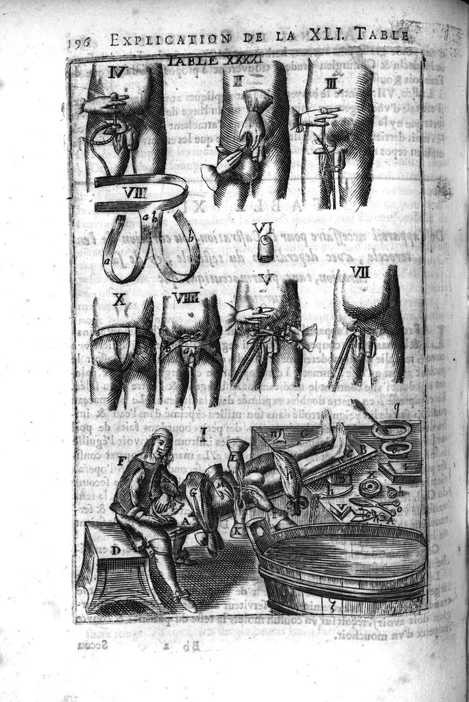 An illustration from L'arcenal de chirurgie, 1675, leaf 211