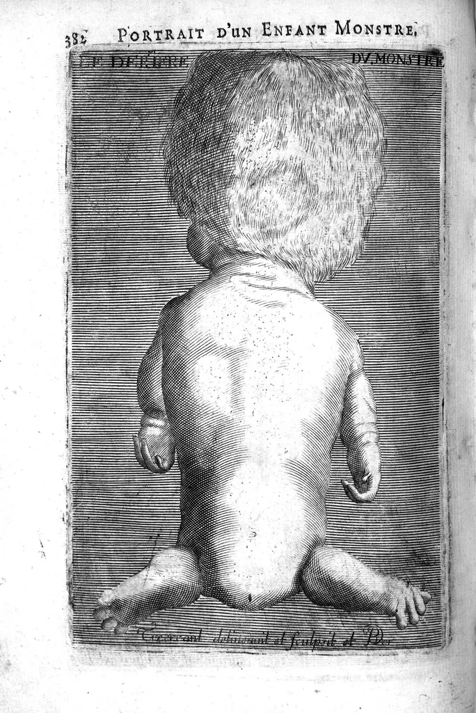 An illustration from L'arcenal de chirurgie, 1675, leaf 397