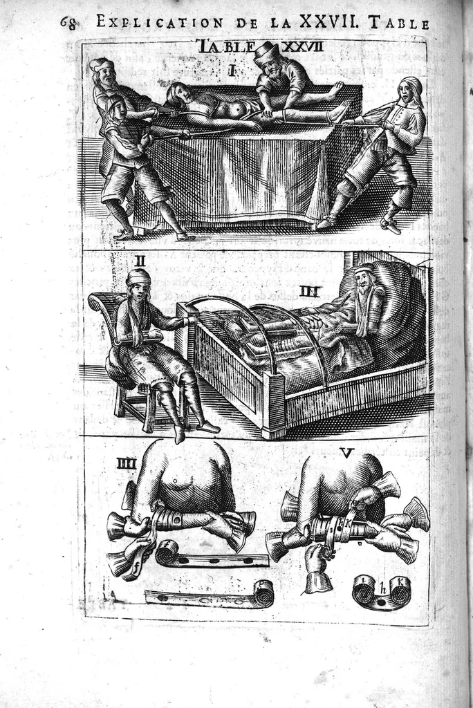 An illustration from L'arcenal de chirurgie, 1675, leaf 83