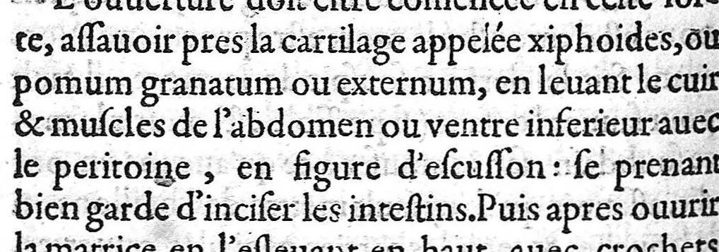 An illustration from Traité des Hernies contenant une ample declaration de toutes leurs especes, et autres excellentes parties de la Chirurgie,assavoir de la pierre, des cataractes des yeux, et autres maladies, desquelles comme la cure est perilleuse, aussi est elle de peu d’hommes bien exercée : Avec leurs causes, signes, accidens, anatomie des parties affectées, et leur entiere guarison : Par Pierre Franco de Turriers en Provence, demeurant à present à Orange, 1561, leaf 395