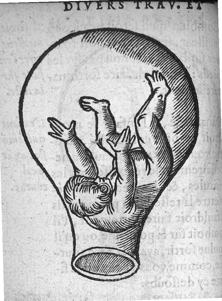 An illustration from Des divers travaulx et enfantemens des femmes. Et par quel moyen lon doibt survenir aux accidens qui peuvent eschoir devant et apres iceux travaulx, devisé en deux petiz livres. Premierement composez en Latin, par maistre Euchaire Rodion, Docteur en Medecine, et depuis tournez en nostre langue Françoyse, et augmentez de Annotations, par M. Paul Bienassis de Poictiers, à l’utilité de plusieurs personnes. Avec Indice des choses memorables contenues en ce present livre, mises par chapitres en la fin d’icelluy, 1563, leaf 75