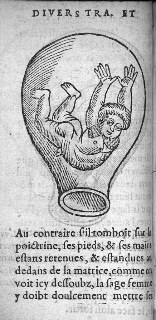 An illustration from Des divers travaulx et enfantemens des femmes. Et par quel moyen lon doibt survenir aux accidens qui peuvent eschoir devant et apres iceux travaulx, devisé en deux petiz livres. Premierement composez en Latin, par maistre Euchaire Rodion, Docteur en Medecine, et depuis tournez en nostre langue Françoyse, et augmentez de Annotations, par M. Paul Bienassis de Poictiers, à l’utilité de plusieurs personnes. Avec Indice des choses memorables contenues en ce present livre, mises par chapitres en la fin d’icelluy, 1563, leaf 77