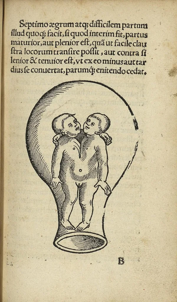 An illustration from De partu hominis, et quae circa ipsum accidunt. Libellus D. Eucharii Rhodionis, 1532, leaf 36