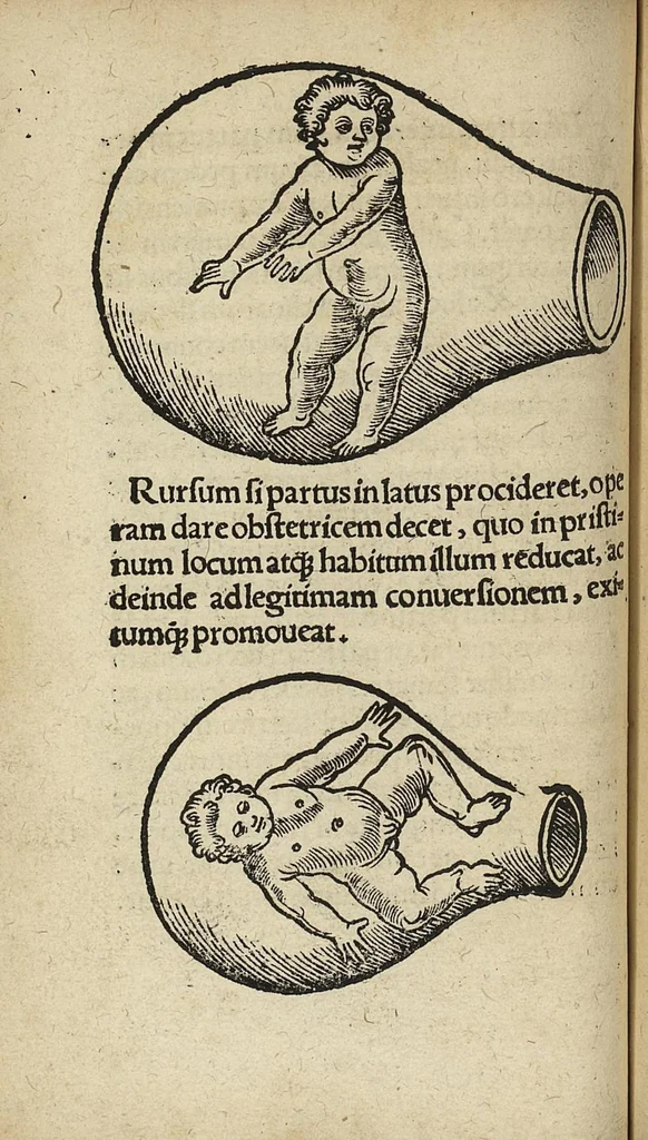 An illustration from De partu hominis, et quae circa ipsum accidunt. Libellus D. Eucharii Rhodionis, 1532, leaf 57