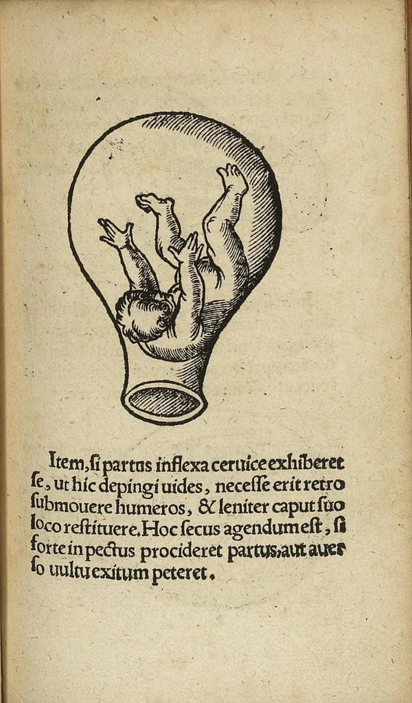 An illustration from De partu hominis, et quae circa ipsum accidunt. Libellus D. Eucharii Rhodionis, 1532, leaf 62