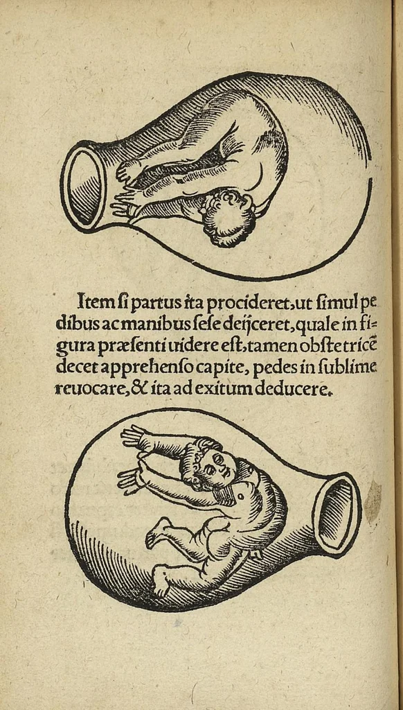 An illustration from De partu hominis, et quae circa ipsum accidunt. Libellus D. Eucharii Rhodionis, 1532, leaf 63