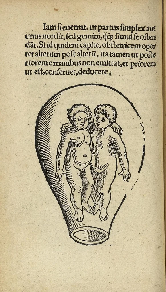 An illustration from De partu hominis, et quae circa ipsum accidunt. Libellus D. Eucharii Rhodionis, 1532, leaf 65