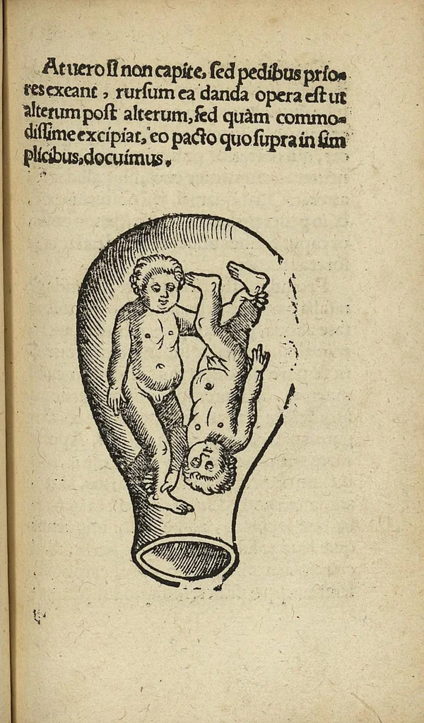 An illustration from De partu hominis, et quae circa ipsum accidunt. Libellus D. Eucharii Rhodionis, 1532, leaf 66