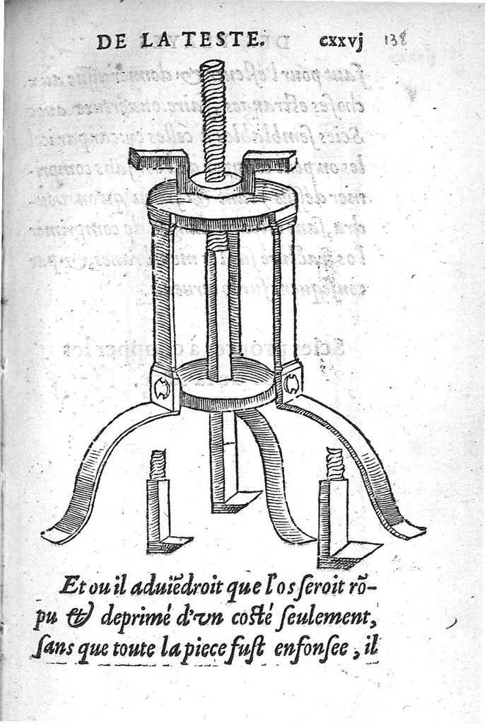 An illustration from La Methode Curative des Playes et Fracture de la teste humaine. Avec les pourtraits des Instruments necessaires pour la curation d’icelles. Par M. Ambroise Paré Chirurgien ordinaire du Roy, et Juré à Paris,, 1561, leaf 274
