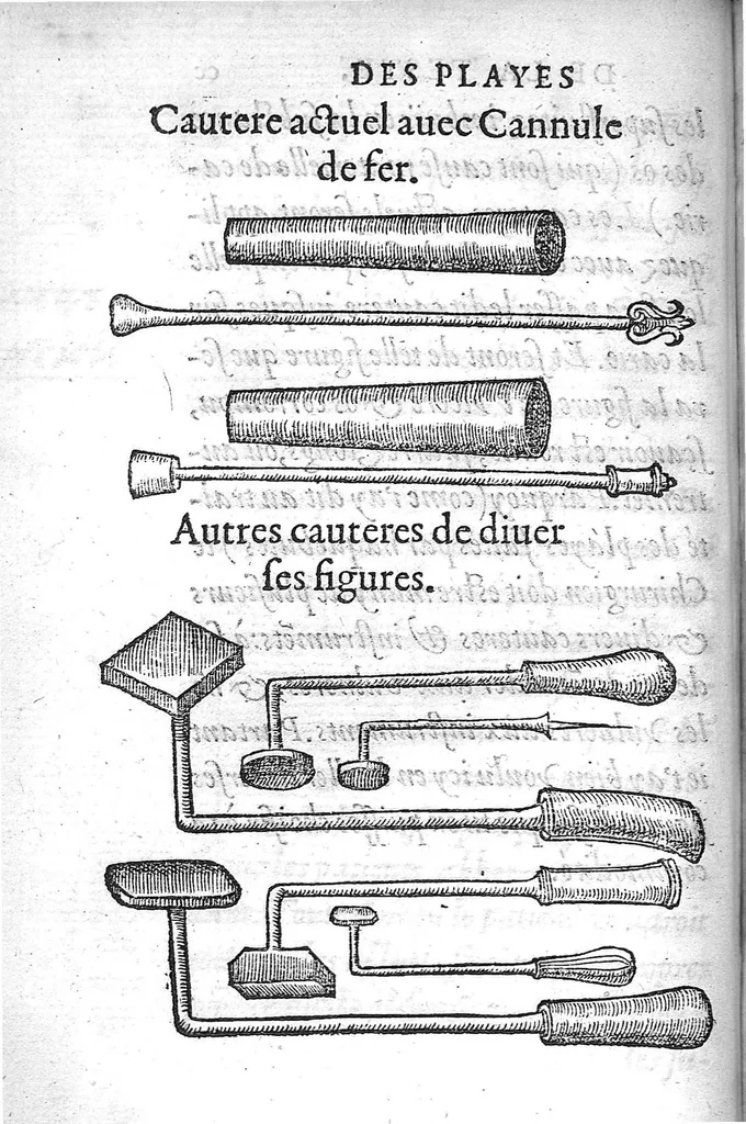 An illustration from La Methode Curative des Playes et Fracture de la teste humaine. Avec les pourtraits des Instruments necessaires pour la curation d’icelles. Par M. Ambroise Paré Chirurgien ordinaire du Roy, et Juré à Paris,, 1561, leaf 423