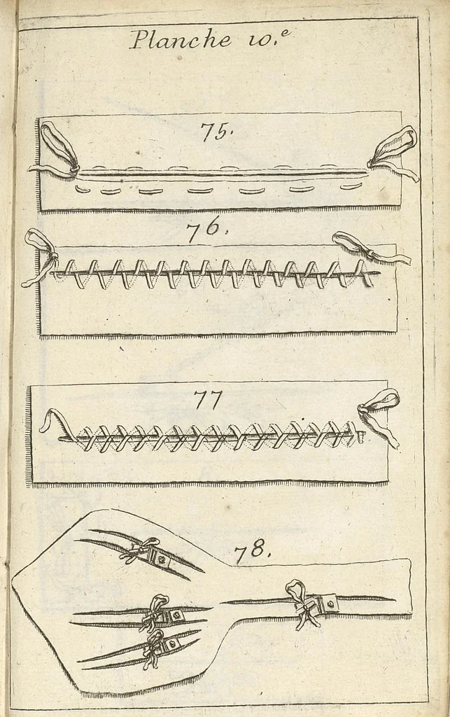 An illustration from Traité complet des operations de chirurgie : contenant leurs definitions, leurs causes expliquées sur la structure de la partie, les signes des maladies qui nous obligent de faire l'operation..., 1698, leaf 900