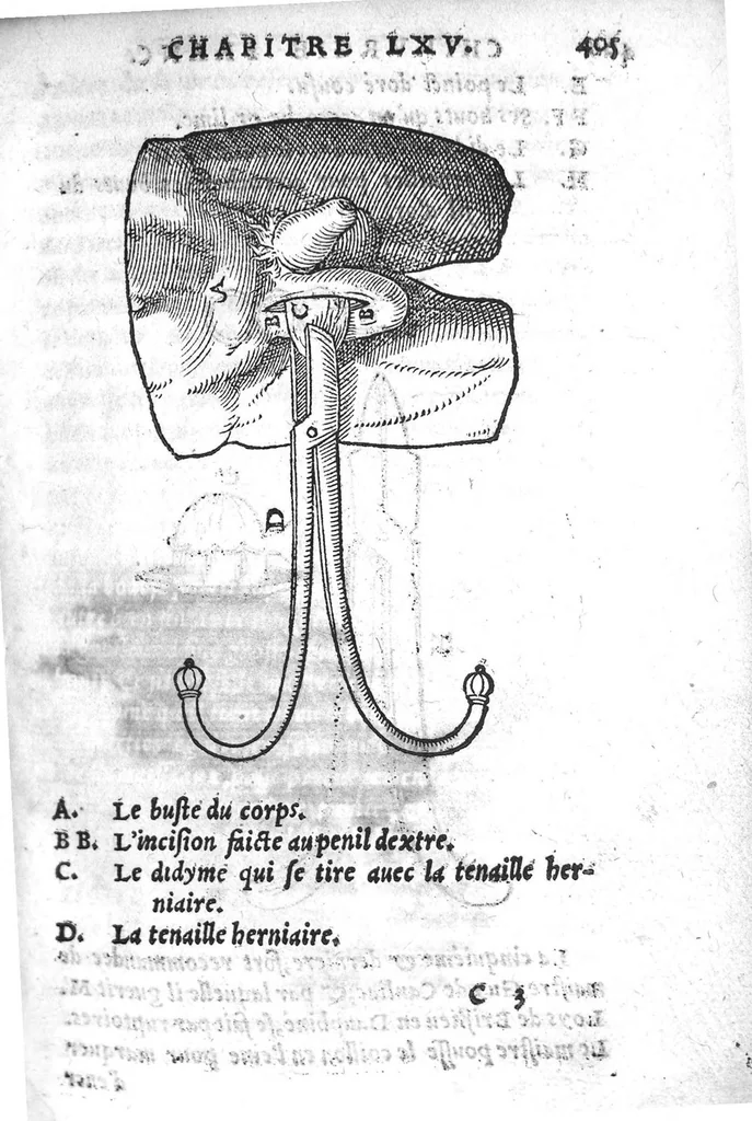 An illustration from Chirurgie françoise, recueillie par M. Jaques Dalechamps, Docteur Medicin, et Lecteur ordinaire de ceste profession à Lyon. Avec plusieurs figures des instrumens necessaires pour l’operation manuelle. La page 14. contient les principaux chefz de ce qui se discourt en cest œuvre,, 1569, leaf 456