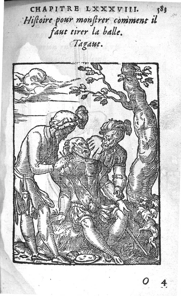 An illustration from Chirurgie françoise, recueillie par M. Jaques Dalechamps, Docteur Medicin, et Lecteur ordinaire de ceste profession à Lyon. Avec plusieurs figures des instrumens necessaires pour l’operation manuelle. La page 14. contient les principaux chefz de ce qui se discourt en cest œuvre,, 1569, leaf 634